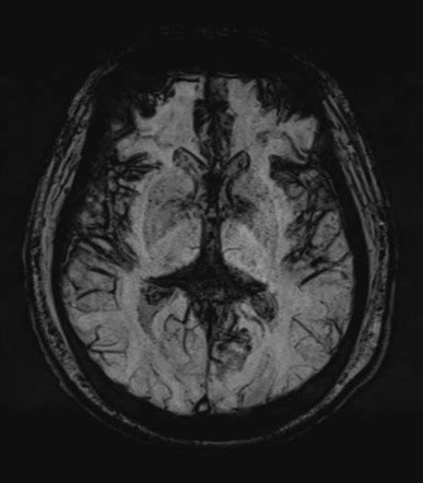 Superficial siderosis | Image | Radiopaedia.org