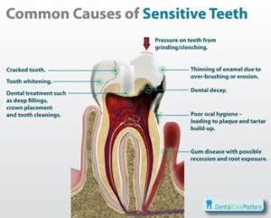 Mint Dental Hygiene - Sensitive Teeth, Causes And Treatment