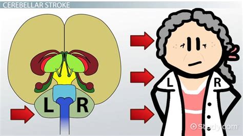 Cerebellar Stroke: Prognosis & Recovery - Video | Study.com