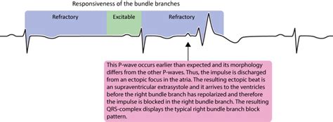 Aberrant ventricular conduction (aberrancy, aberration ...