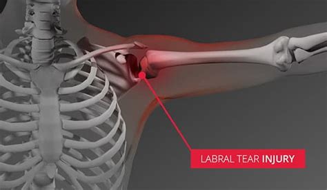 Do you have a Shoulder Labarum Tear or Shoulder Tendonitis ? - Clearcut ...