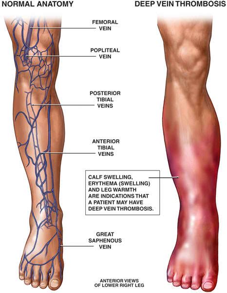 10 Deep Vein Thrombosis (DVT) Facts | Thrombocytes