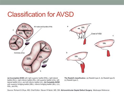 Surgical Repair of Atrioventricular Septal Defect – Dimas Yusuf