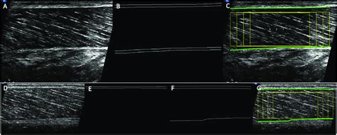 Examples of raw images of the ultrasound field of view, aponeuroses... | Download Scientific Diagram