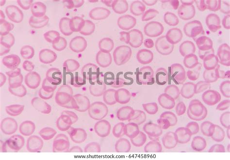 Hypochromia On Blood Smear Patient Thalassemia Stock Photo 647458960 | Shutterstock