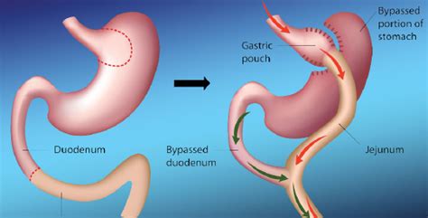 Roux-en-Y Gastric Bypass