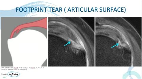 MRI Shoulder Rotator Cuff Footprint Tears - Radedasia