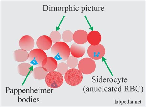 Anemia:- Part 9 - Sideroblastic Anemia, and Anemia Due To Chronic Diseases - Labpedia.net