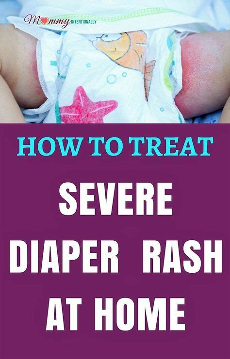 Most Effective Ways of Treating Diaper Rash in Babies | Diaper rash, Treating diaper rash, Good ...