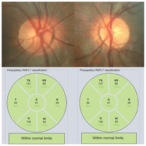 At the end of follow-up (4 months), a normal cup-to-disc ratio was seen ...