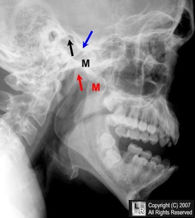 Learning Radiology - Dislocated, Mandible, Mandibular, Dislocation