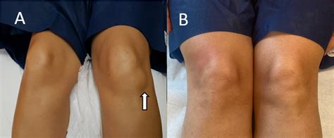 Cureus | Musculoskeletal Ultrasound Diagnosis of Symptomatic Hoffa’s ...