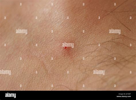 Black fly bite, skin, people, São Paulo, Brazil Stock Photo - Alamy