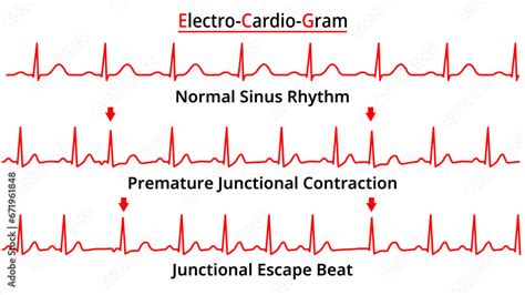 Set of ECG Common Abnormalities - Junctional Escape Beat - Premature ...