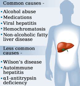 Causes of high liver enzymes | High liver enzymes, Elevated liver ...