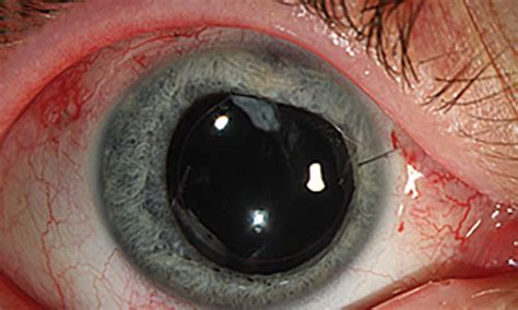 Traumatic eye injury from an exploding aerosol can | The Medical Journal of Australia