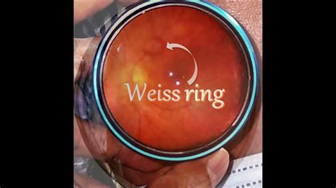 Weiss ring as seen on Indirect ophthalmoscopy #shorts - YouTube