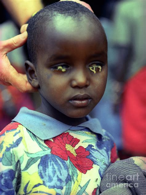 Trachoma Eye Infection Treatment Photograph by Jason Kelvin/science Photo Library - Pixels