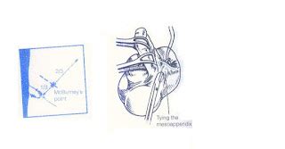 OTMANAGE: APPENDICECTOMY PROCEDURE