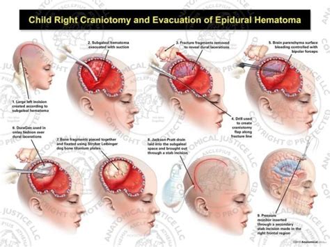 Child Right Craniotomy and Evacuation of Subgaleal Hematoma