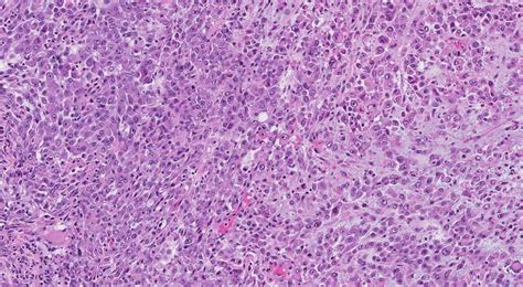 Epithelioid sarcoma | Ottawa Atlas of Pathology