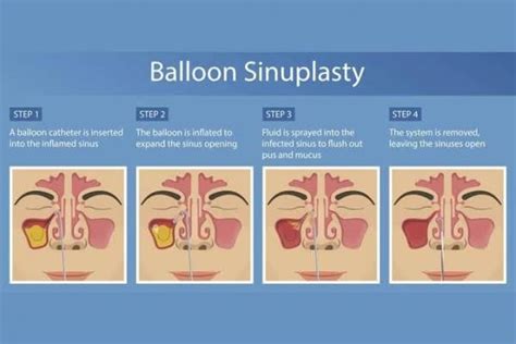 Balloon Sinuplasty: A Minimally Invasive Procedure To Treat Chronic Sinusitis | Add More to Life ...