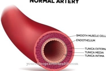 As a result of a reduced blood flow in the anterior spinal artery, a typical symptom develops ...