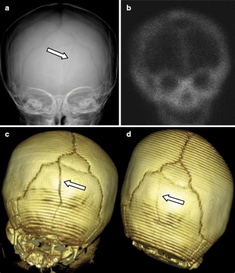 Occipital fracture that was mistaken for an accesory su | Open-i