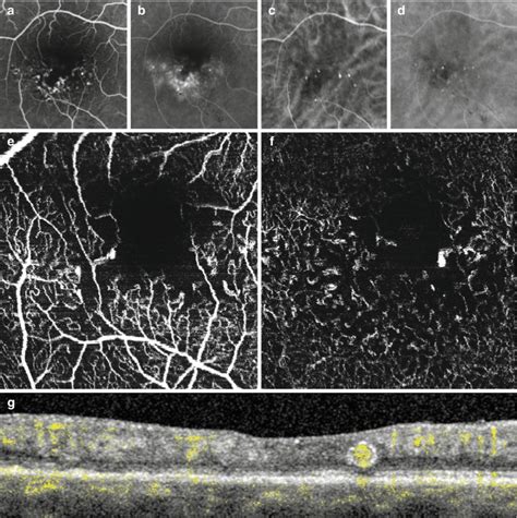 OCT Angiography (OCTA) in Retinal Diagnostics - High Resolution Imaging ...