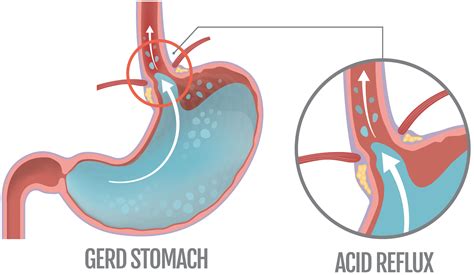 Acid Reflux Blog – Detox Organics