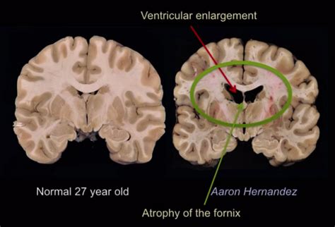 The Neurocritic: Netflix Neurology: Inside the Brain of Aaron Hernandez (for a few seconds)