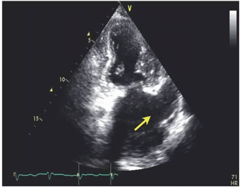 The Left Atrium and the Left Atrial Appendage | Thoracic Key