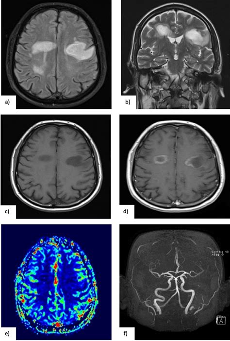 Vanishing Pseudotumoral White Matter Lesions Presenting as Aphasia and ...