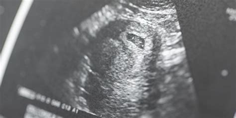 Anomaly Scan: Why the 20-Week Ultrasound is Important