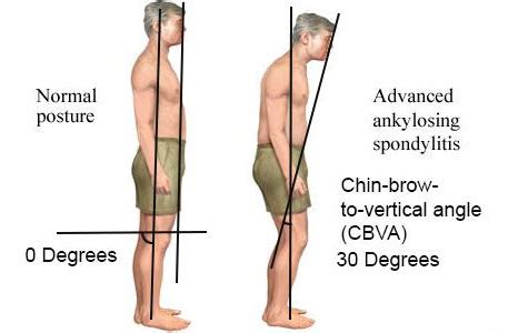 Ankylosing Spondylitis: Causes, Symptoms, And Treatments