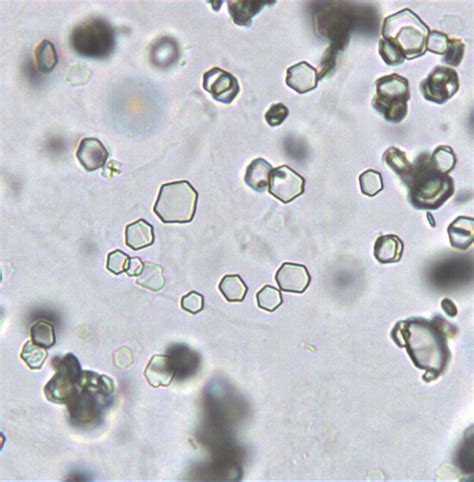 Cystine crystals showing colorless, refractile, and hexagonal plates ...