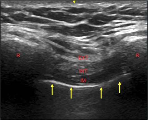 Ultrasound Guided Intercostal Block