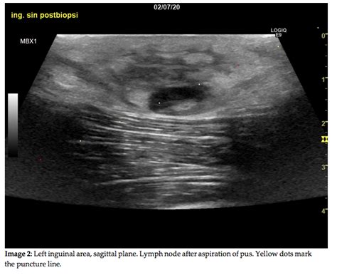 Case of the Month July 2021- Palpable inguinal lymph nodes – WFUMB