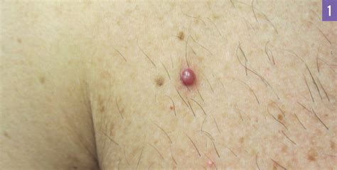 Pyogenic Granuloma In Pregnant Women