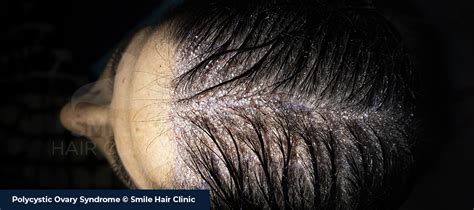 Polycystic Ovary Syndrome (PCOS) Hair Loss - Smile Hair Clinic