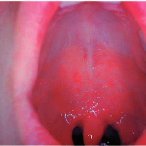 Koplik spots are the small white spots on the pharynx (Reproduced with... | Download Scientific ...