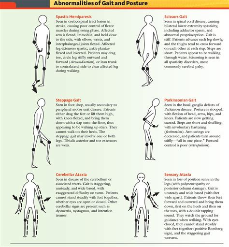 Abnormalities of Gait and Posture. Spastic Hemiparesis Scissors ... | GrepMed