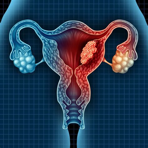 Phase 3 KEYNOTE-775/Study 309 Trial Meets Dual Primary End Points in Advanced Endometrial Cancer