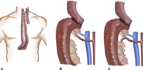 Supercharged cervical anastomosis for esophagectomy and gastric pull-up ...