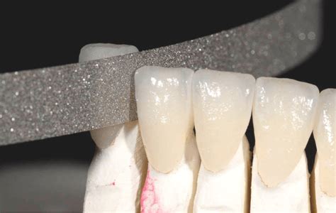 NTI Diamond Finishing Strips | Prestige Dental