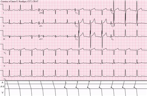 Wandering atrial pacemaker - Wikipedia