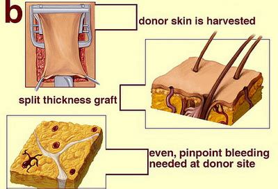 Skin Beauty - Skin Grafting Technique