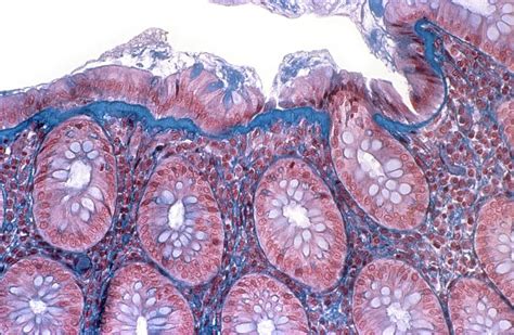 Collagenous Colitis Photograph by Cnri/science Photo Library | Fine Art ...