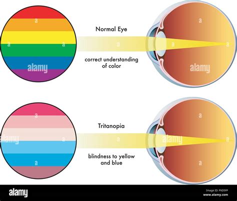 Color blindness hi-res stock photography and images - Alamy