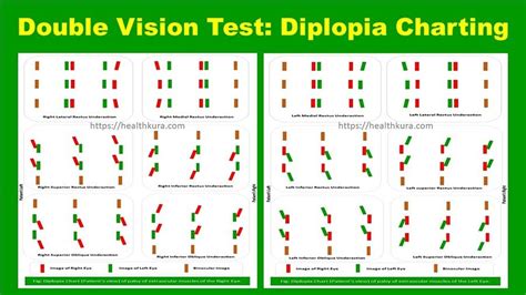 Diplopia Charting: Double Vision Test Chart Online | Double vision ...